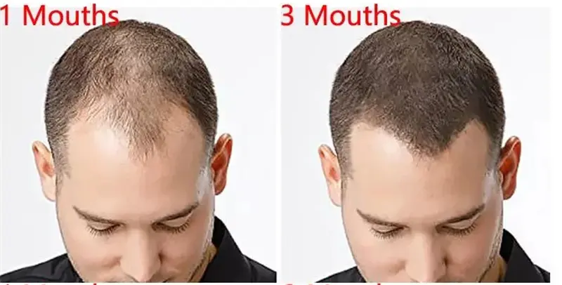 Minoxidil for hair