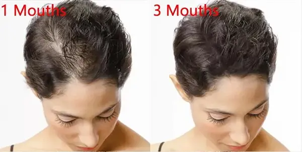 Does minoxidil really regrow hair? Minoxidil-the bald killer