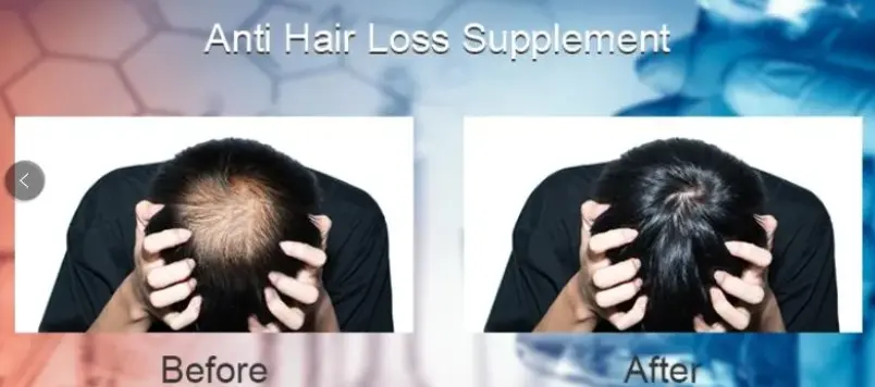 Minoxidil Hair Growth Spray Suitable For