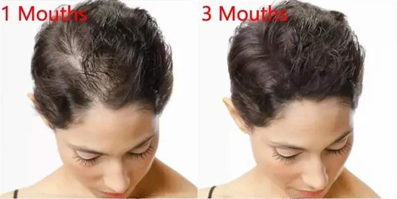 Minoxidil for hair