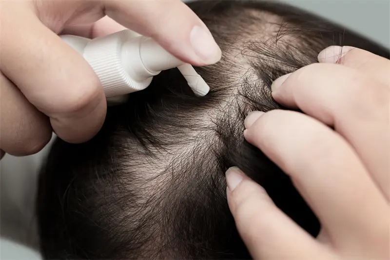 Minoxidil for hair